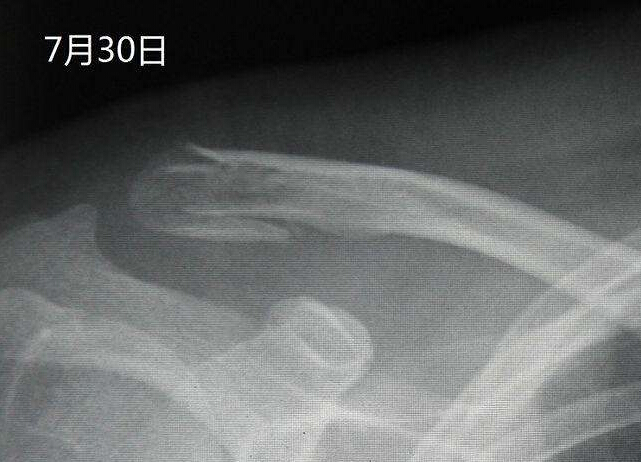 探花视频在线仪X线检查对骨折的诊断有什么意义？