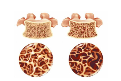 探花视频在线仪生产厂家分享自己也能检测是不是存在骨质疏松？