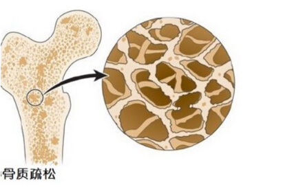 探花视频在线检测仪阐述多吃醋会让骨钙溶出而流失造成骨质疏松