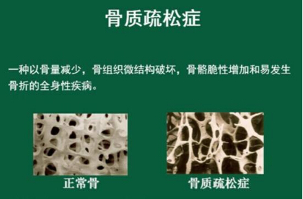 探花视频在线仪怎么样检测骨质疏松，能够正确的分析探花视频在线正常值