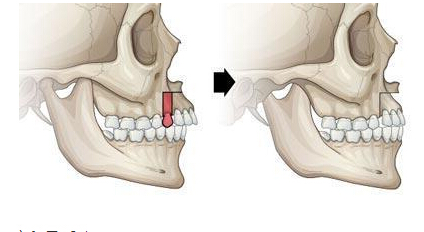 超声波探花视频在线仪检测探花视频在线,人到中年牙齿松动真的是人老不中用吗？