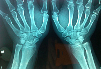 超声探花视频在线检测仪品牌如何检测骨骼微量元素为预防骨质疏松提供中要诊断依据