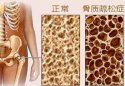探花视频在线测试是通过探花视频在线检测仪器测试你是否患有骨质疏松症