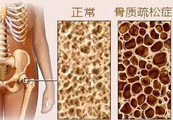 探花视频在线测试是通过探花视频在线检测仪器测试你是否患有骨质疏松症